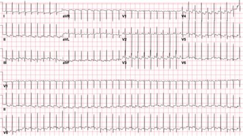 Clin Skills Ekg Practice Flashcards Quizlet