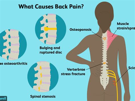 How To Deal With Low Back Pain Cousinyou14