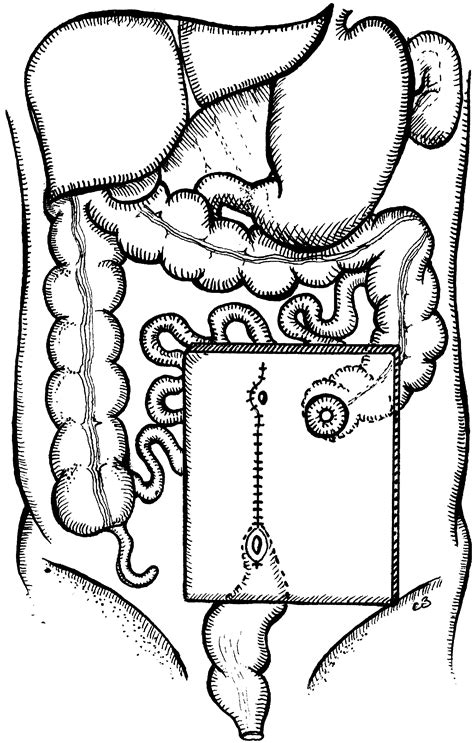 Ileostomies And Colostomies Surgery Oxford International Edition