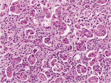 Invasive Micropapillary Carcinoma With Giant Cell Like Appearance And