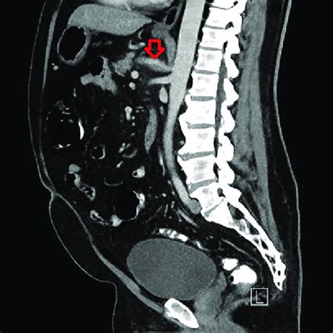 Initial Ct Of The Abdomen And Pelvis With Iv Contrast Illustrating