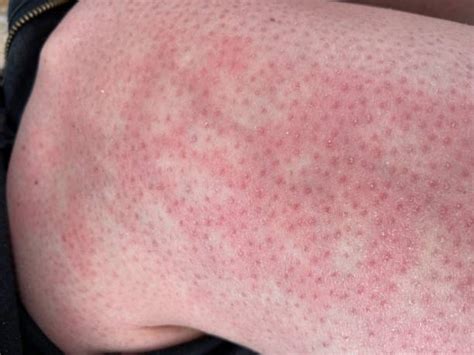 Red Blotches On Legs Stock Photos Pictures And Royalty Free Images Istock