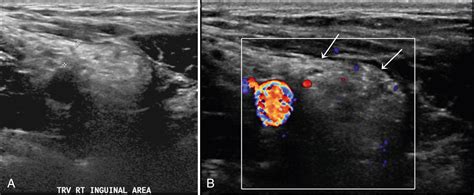 Dynamic Ultrasound Of Hernias Of The Groin And Anterior Abdominal Wall