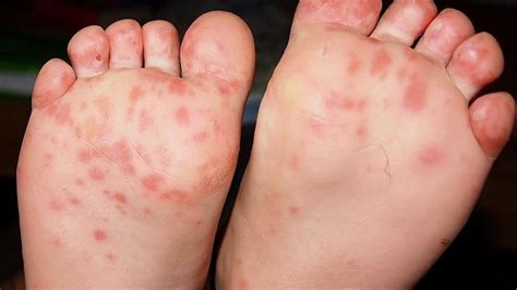 Mcc Second Case Of Hand Foot And Mouth Disease Reported On Campus Weyi