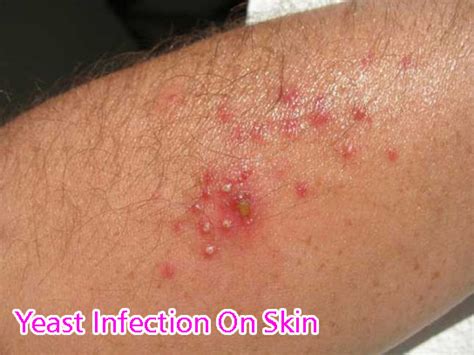 Skin Yeast Infection Pictures Photos Free Download Nude Photo Gallery