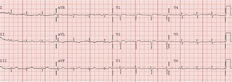 Dr Smiths Ecg Blog Progression Of Anterior Stemi With Rbbb And