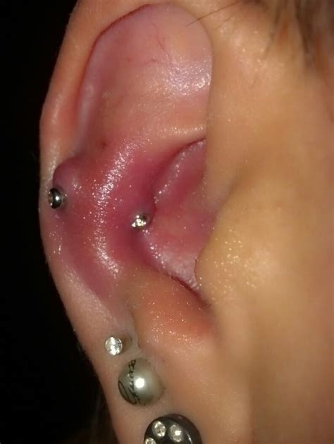 Infected Snug Piercing Almost A Good Idea Piercings Infected Ear Piercing Ear Piercings