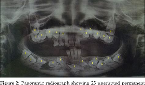 Figure From Primary Failure Of Eruption Combined With Bilateral