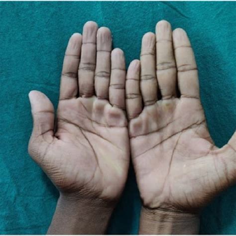 Borderline Tuberculoid Leprosy Lesion On Middle Finger With Visible