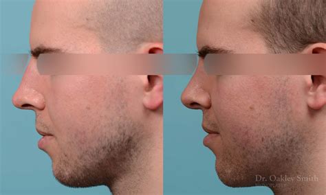 rhinoplasty before and after case 278 toronto rhinoplasty surgery nose surgery by dr oakley