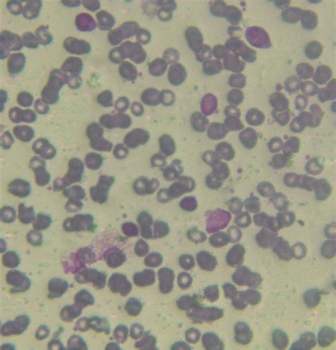 Peripheral Blood Smear With Cll And Aiha Revealing Lymphocytosis And