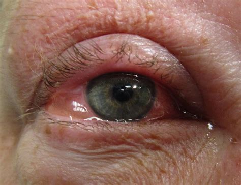 Allergic Conjunctivitis Everything You Need To Know