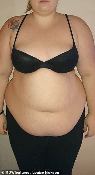Size 22 Woman Sheds Eight Stone In A Year After Having Vertical Sleeve Gastrectomy Surgery