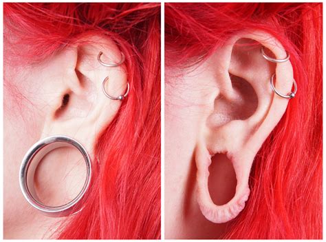 Stretched Earlobe Repair Surgery Following Gauge Earring