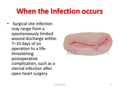 Surgical Site Infections Prevention And Care