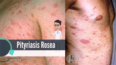 What Is Pityriasis Rosea Youtube