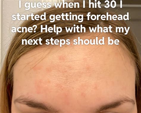Skin Concern Forehead Acne What Products Should I Try R