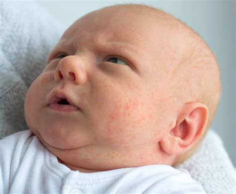 Baby Acne Causes Symptoms And How To Treat Baby Acne Emmas Diary