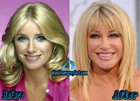 Suzanne Somers Plastic Surgery Before And After Plastic Suzanne Somers Plastic Surgery