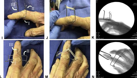 Dynamic Homemade Digital External Fixators For Proximal