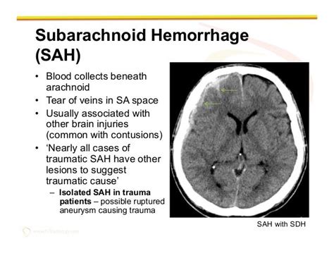 Subarachnoid Hemorrhage Subarachnoid Hemorrhage Basic Anatomy And