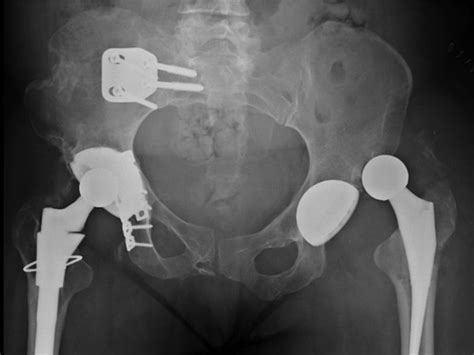 Anterior Hip Dislocation Following Revision Left Total Hip