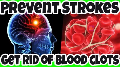 Natural Ways To Get Rid Of Blood Clots To Prevent Strokes And Heart