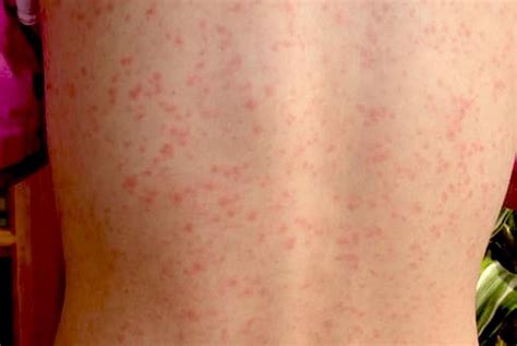 Scarlet Fever Causes Symptoms Treatment And Complications Strep