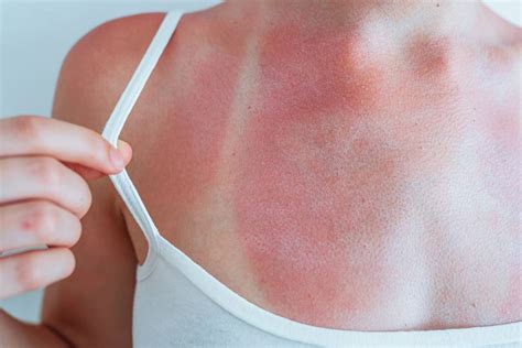 Sunburn Vs Sun Poisoning Symtomps Treatment And More