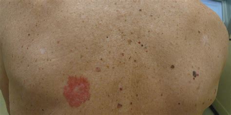 Skin Cancer Symptoms Pictures Photos Types Signs Melanoma