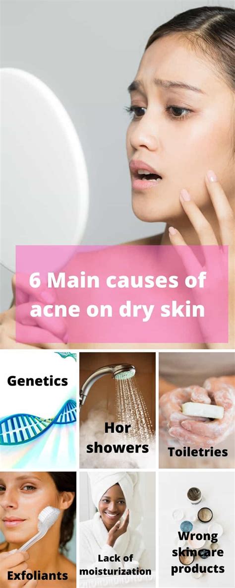 Dry Skin Acne Build Your Body