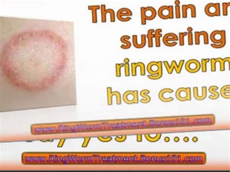 How To Treat Ringworm In Humans Treating Ringworm Ringworm
