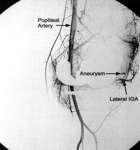 Periarticular Aneurysm Following Total Knee Replacement In H Jbjs