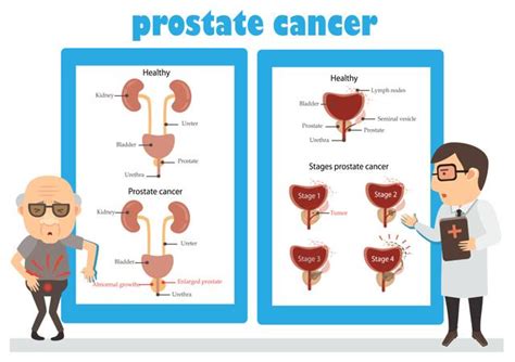 Having Several Sexual Partners Doubles Prostate Cancer Risk In Men