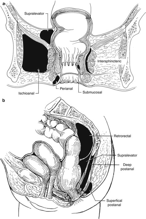 Anorectal Abscess คอ Anorectal Abscess And Fistula In Ano ราชวทยาลย