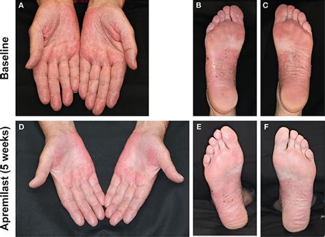 Treatment Psoriasis On Palms Of Hands