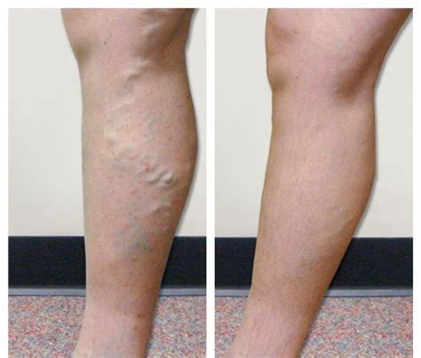 Varicose Veins Disorders And Procedures Vein Specialists Of The Carolinas