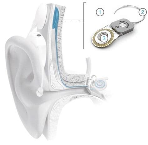 Cochlear Implant External And Internal Components Cochlear Implants