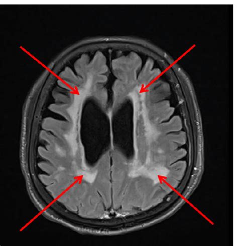 Small Blood Vessel Disease Cerebral Changes Brain Mri Resonance Matter