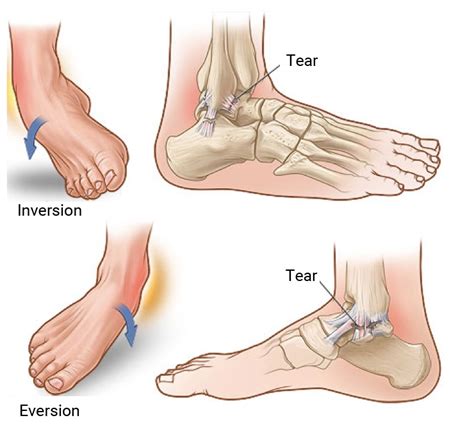 Preventing And Managing Ankle Sprains