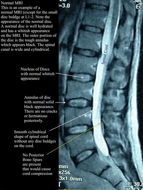 Lumbar Spine Image Radiology Imaging Medical Anatomy Medical Knowledge