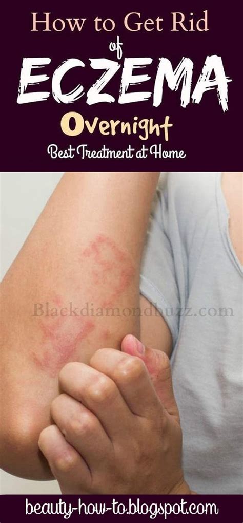 How To Get Rid Of Eczema Fast At Home How To Beauty