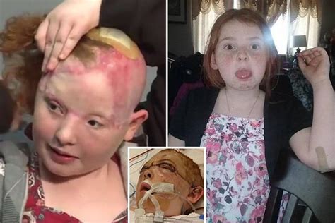 Girl 12 Whose ‘pretty Hair Was Ripped Off After Getting Caught In