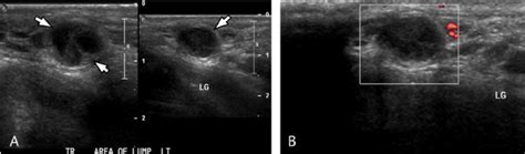 Sperm Cell Granuloma Ultrasound