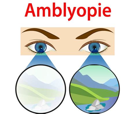 Lamblyopie Causes Symptômes Et Traitements Information