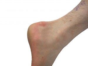 Insertional achilles tendonitis refers to inflammation of the achilles tendon at the point where the promote healing through traditional rest, ice, stretching, massage, etc. Insertional Achilles tendinosis often begins with a bone ...