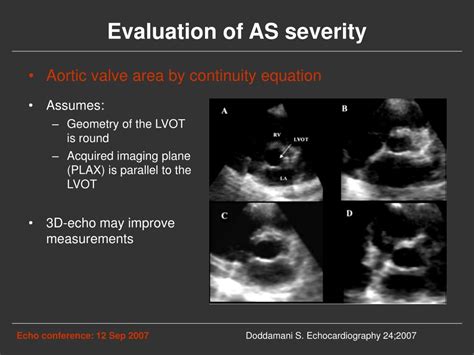 Ppt Aortic Stenosis Powerpoint Presentation Free Download Id4646664