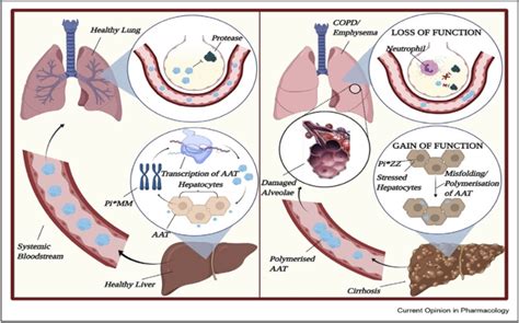 Why Does Alpha 1 Antitrypsin Deficiency Cause Liver Disease Aasld
