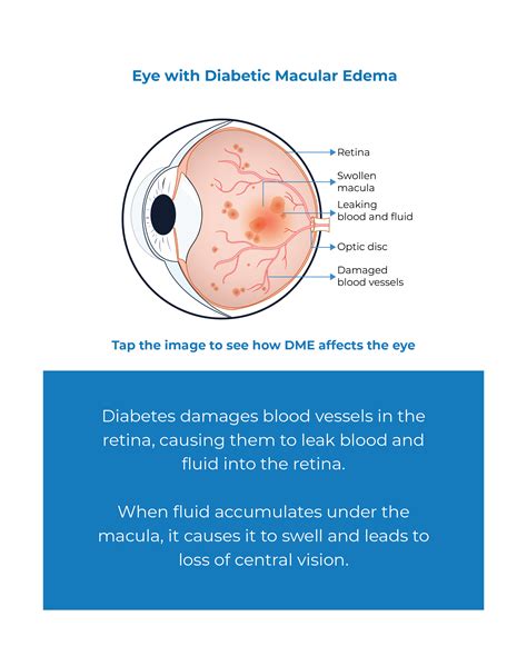 Dme Diabetic Macular Edema Kodiak Sciences