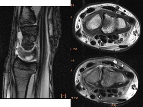 Wrist Arthroscopy Turkey Case 01 Scapholunate Ganglion Cyst
